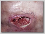pressure ulcer