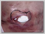 pressure ulcer