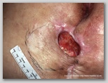 pressure ulcer