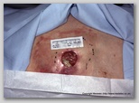 pressure ulcer