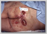 pressure ulcer