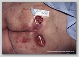 pressure ulcer