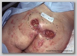 pressure ulcer