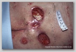 pressure ulcer