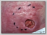 pressure ulcer