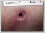 pressure ulcer