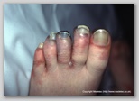 wound image
