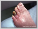 wound image