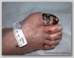 wound image