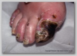 wound image