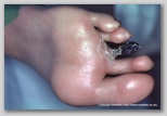 wound image