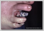 wound image