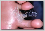 wound image
