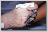 wound image