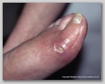 wound image