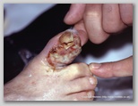 wound image