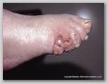 wound image