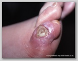 wound image