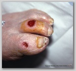 wound image