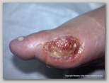 wound image