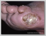 wound image