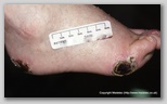 wound image