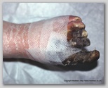 wound image