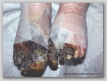 wound image