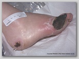 wound image