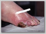 wound image