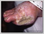 wound image