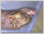 wound image