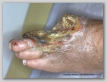 wound image