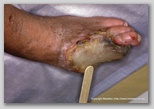 wound image