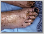 wound image